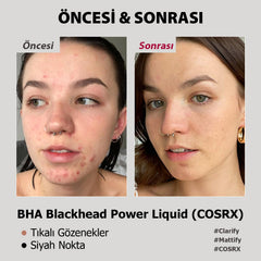 COSRX - BHA Blackhead Power Liquid