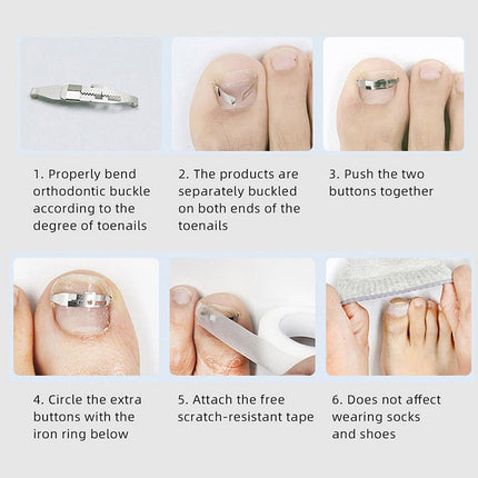Ingrown Toenail Corrector Kit | Professional Carbon Steel Nail Correction Tool