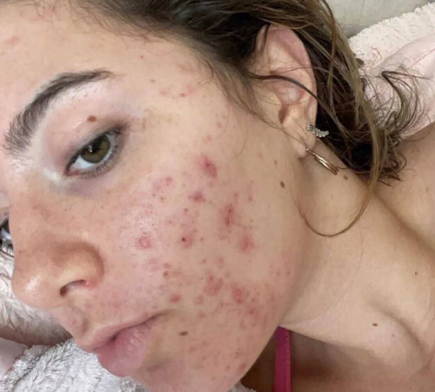 PanOxyl Akne Temizleyici Köpük – %10 Benzoil Peroksit ile Maksimum Güçlü Antibakteriyel Etki