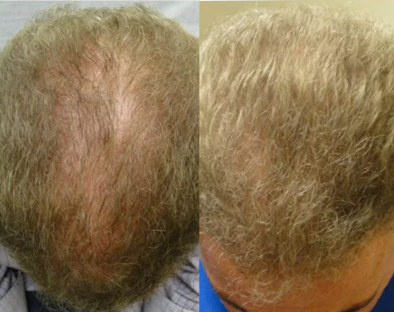 Lustrao Hair Regrowth Oil bottle with botanical ingredients like rosemary, peppermint, and ginseng