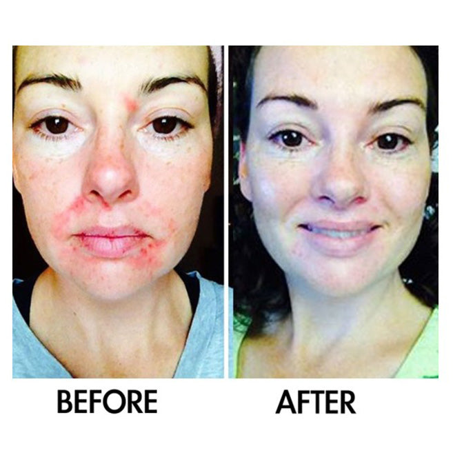 Acne and rosacea serum with prebiotic technology