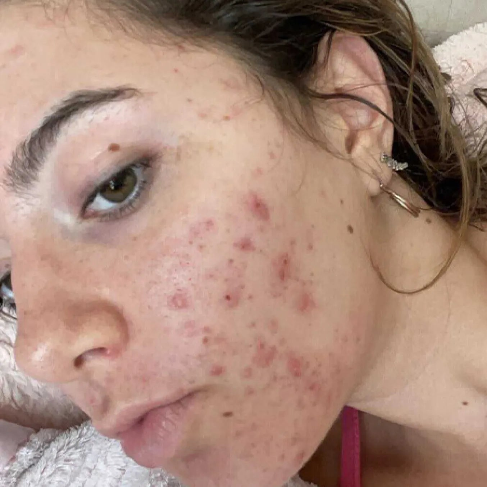 PanOxyl Akne Temizleyici Kopuk